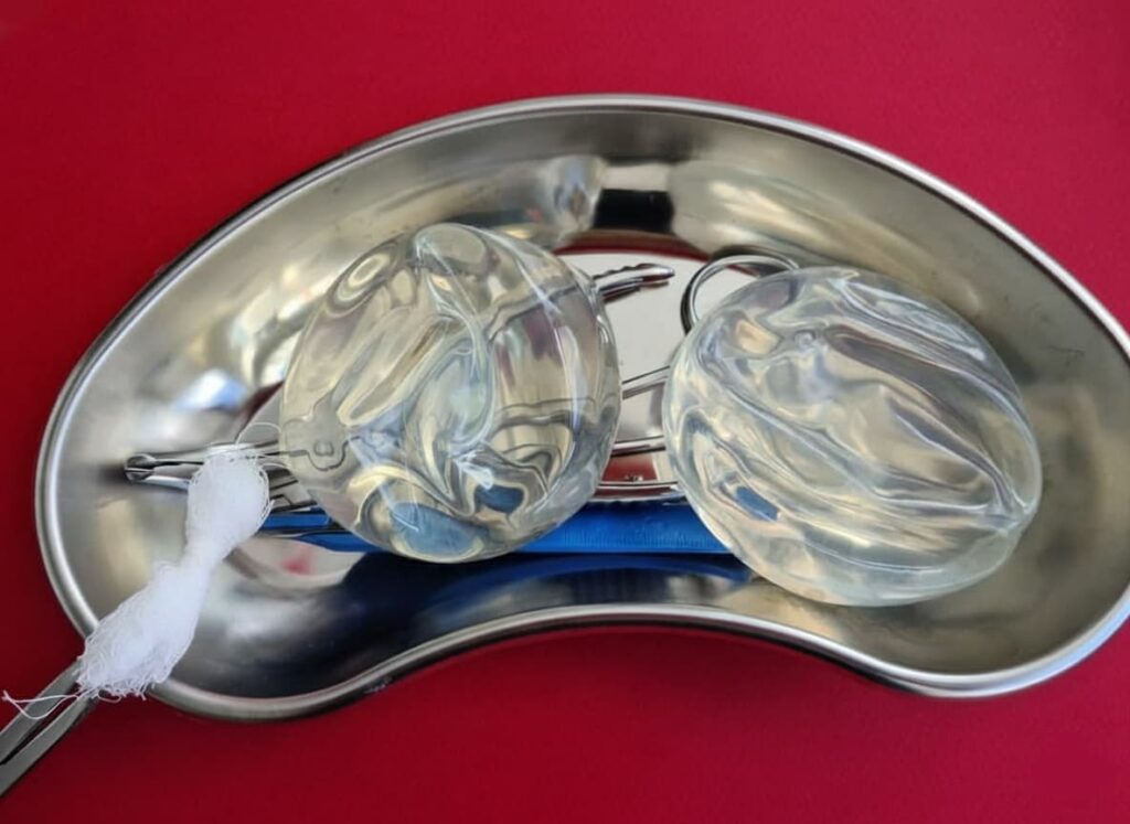 Implantes mamarios de silicona extraídos en una bandeja quirúrgica durante un procedimiento de retirada o extracción de implantes mamarios.