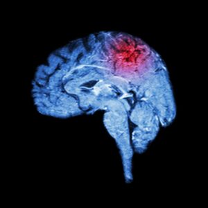 Magnetic Resonance Imaging (MRI) of the brain and stroke – a concept in medical science and healthcare.