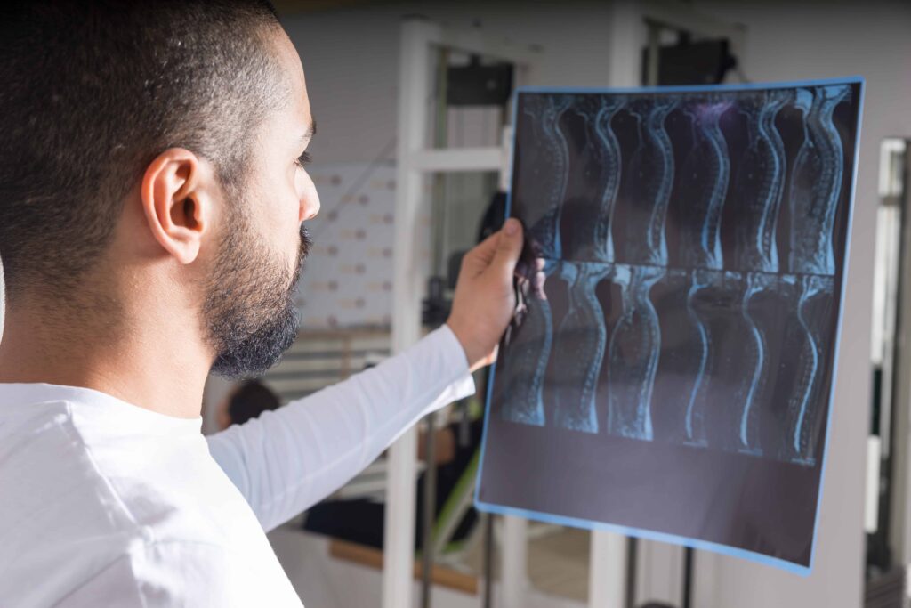 Doctor examining spinal X-ray scan showing vertebrae alignment and possible back injury